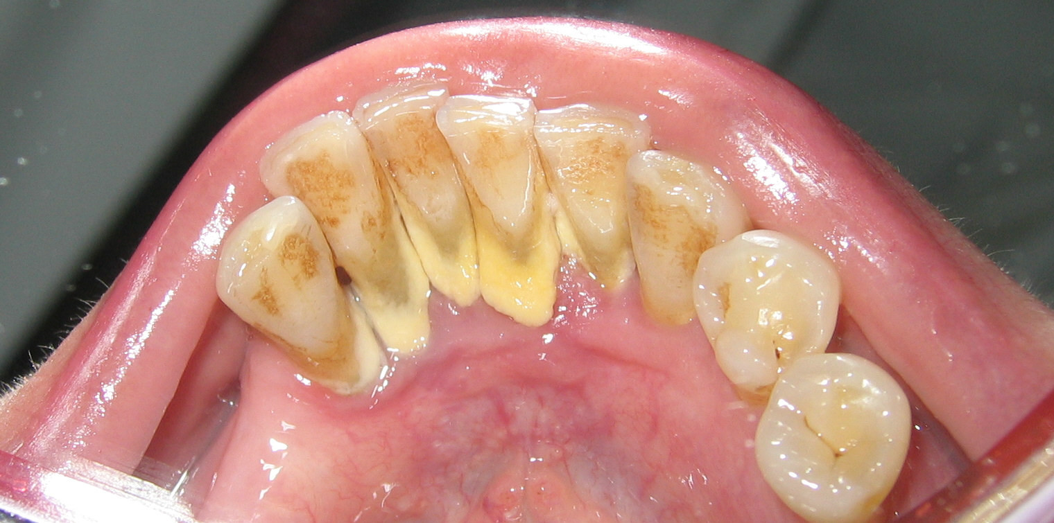 Periodontitis